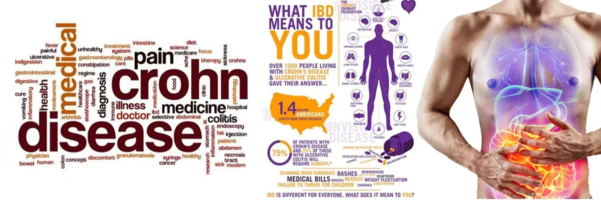 CROHN'S DISEASE & ULCERATIVE COLITIS